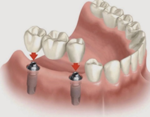 Implant Retained Bridge