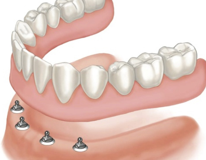Implant Retained Denture