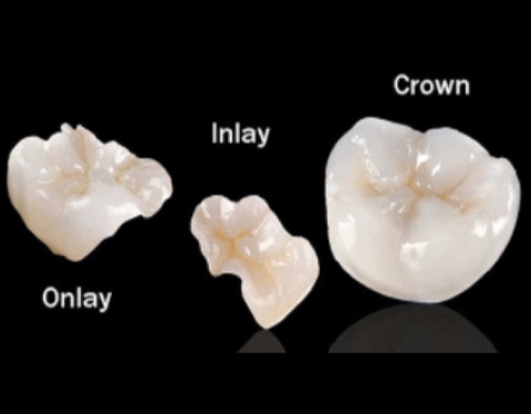 Inlays and Onlays