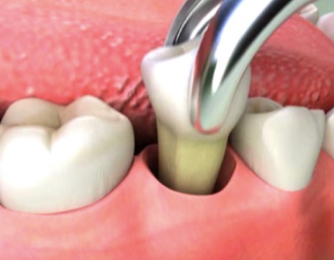 Oral Surgery