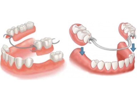 Complete & Partial Dentures