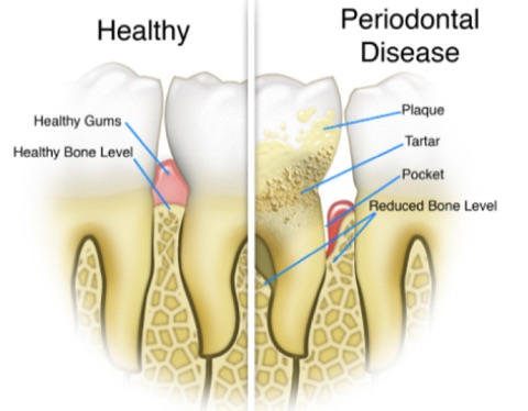 Periodontal Treatment