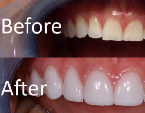 Porcelain Veneers