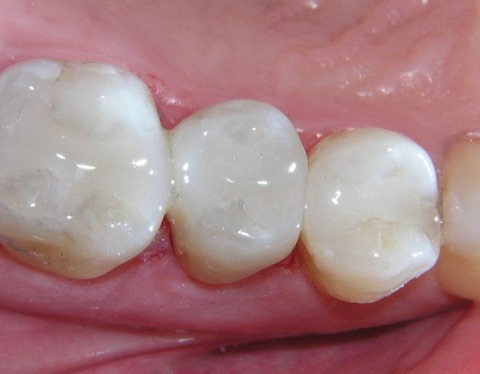 Composite Fillings