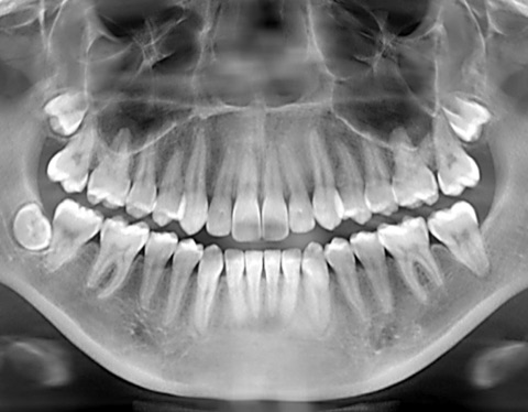 Dental Radiographs (x-rays)