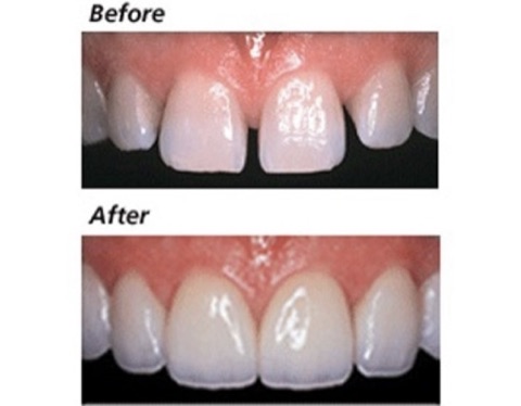Resin Bondings (Composite Veneers)