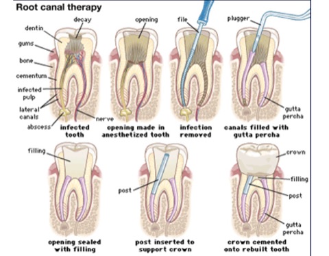 Root Canal Therapy