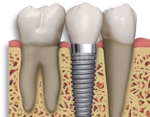 Single Implants