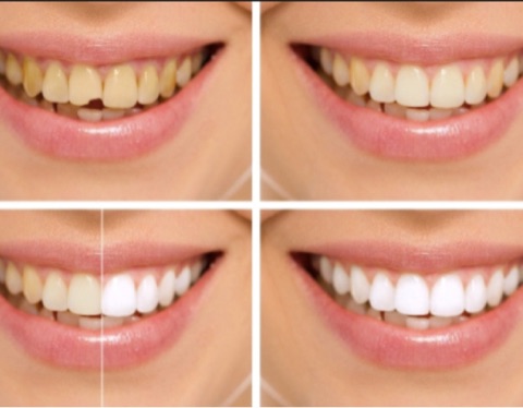 Smile Make Overs