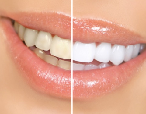 Teeth Whitening